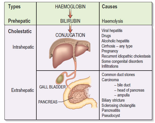 Causes of jaundice